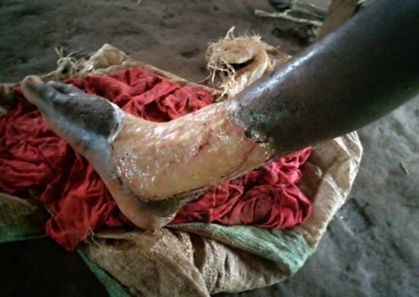 Buruli Ulcer : Creating family disharmony beyond the disease, By TERFA KENE 1 Kene 1