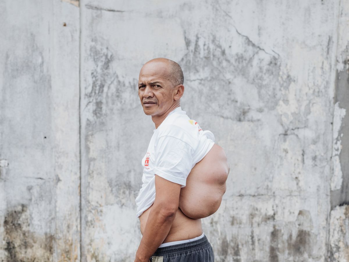 For the first time in 15 years, farmer can sleep on his back after tumor removal by Mercy Ships 2 back tumour 001 006041