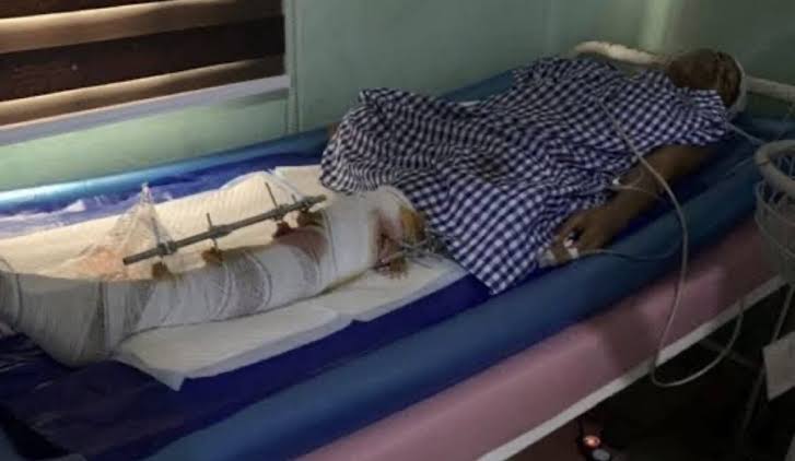 Ruth Otabor lying in the hospital bed after the tragic truck accident that left one of her legs amputated 