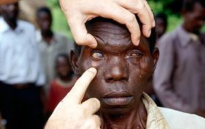 Over 4 million Nigerians suffer from blindness — Sightsavers