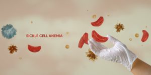 Nigeria accounts for over 1.5 million children with sickle cell disease, highest in the world – New Lancet study shows